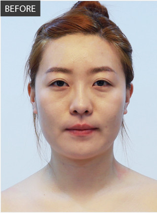 巴诺巴奇整形医院-韩国佰诺佰琪医院全脸脂肪移植对比图