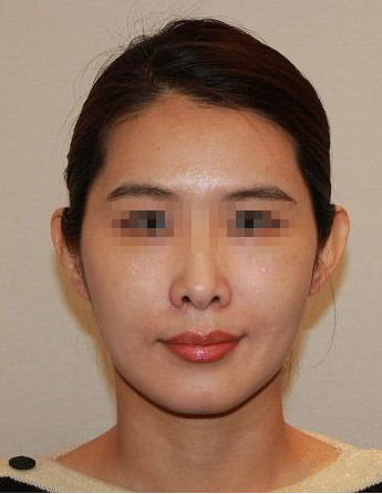 韩国Smile整形外科-自体脂肪填充对比图