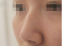 韩国4ever整形外科硅胶隆鼻日记对比图