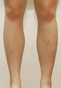 DrChois整形外科诊所-吸脂瘦腿对比日记