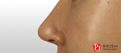 韩国如妃整形外科隆鼻整形对比案例