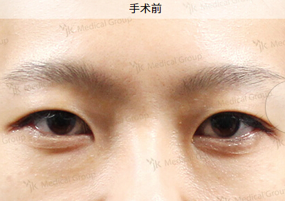 JK整形美容医院-韩国jk医院双眼皮手术整形对比案例