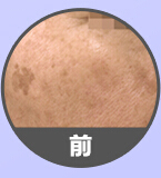 韩国姜韩皮肤科-祛斑手术对比日记