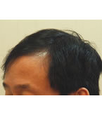 韩国狎鸥亭延世-男士脱发植发对比日记