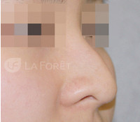 韩国LAFORET整形医院-隆鼻手术对比图
