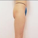 韩国芙莱思整形-丰臀手术对比图