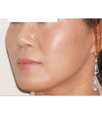 橄榄整形外科-韩国橄榄整形外科下巴下颌角整形手术对比日记