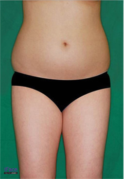 韩国iface整形外科-腹部吸脂对比图