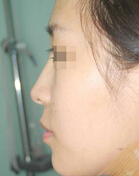 韩国CELLA微整形医院-隆鼻整形前后对比日记图