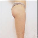 韩国芙莱思整形-丰臀手术对比图