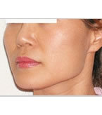 韩国橄榄整形外科下巴下颌角整形手术对比案例