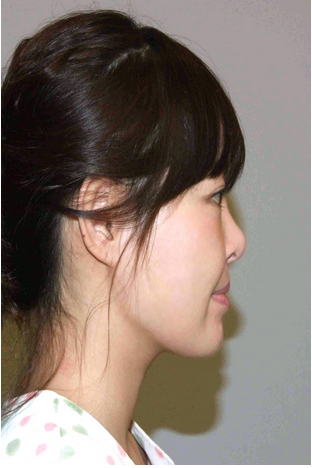 面部轮廓手术案例对比图