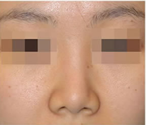 韩国TIAN整形-隆鼻手术案例对比图