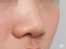 韩国NYPS整形外科隆鼻手术案例对比图_术前