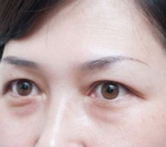 韩国美Q美容整形外科-去眼袋手术日记对比图