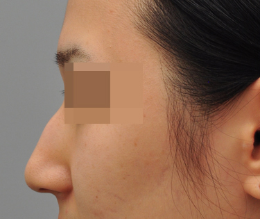 韩国POSSOM-隆鼻手术日记对比图
