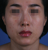 韩国ROSE皮肤科医院-面部脂肪填充对比日记