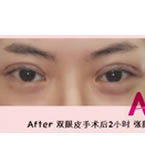 韩国AI整形-韩国AI整形外科双眼皮手术对比日记