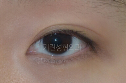 韩国绮林整形-双眼皮+开眼角整形日记
