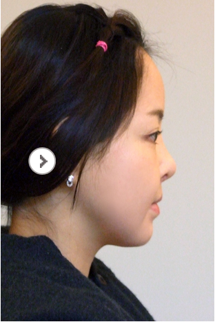 面部轮廓手术案例对比图_术后