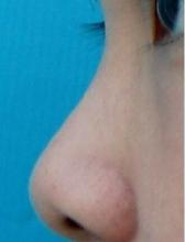 隆鼻手术案例对比图_术前