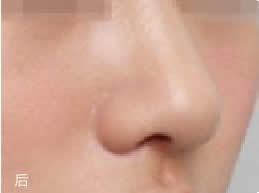 韩国NYPS整形外科隆鼻手术案例对比图_术后