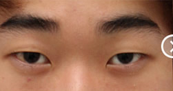 韩国美知整形外科医院-双眼皮手术案例对比图