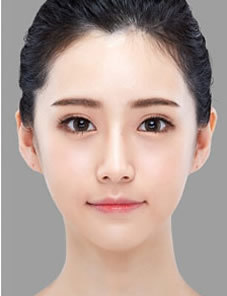 韩国HG-下颌角整形日记对比图