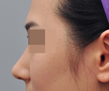韩国POSSOM-隆鼻手术日记对比图