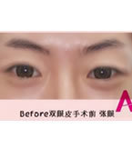 韩国AI整形外科双眼皮手术对比日记