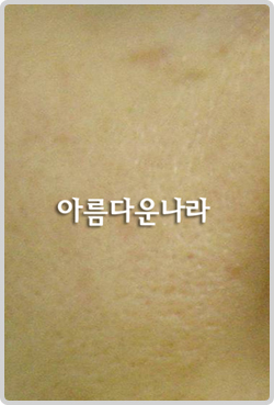 韩国安娜柯琳-毛孔缩小对比图
