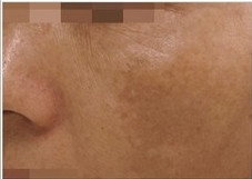 韩国BYoung皮肤科-祛斑对比图