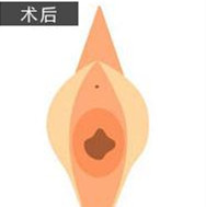 Hansarang女性整形-韩国hansarang妇科医院处女膜修复对比图