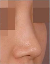 韩国LaMar整形医院-假体隆鼻手术日记对比图