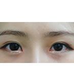 韩国江南三星整形外科-江南三星医院双眼皮手术对比案例