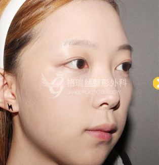 韩国格瑞丝整形外科-韩国格瑞丝整形外科面部填充案例对比图