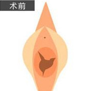 Hansarang女性整形-韩国hansarang妇科医院处女膜修复对比图