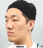 韩国Profile-v-line+双鄂手术+丰额头+眼部整形对比日记