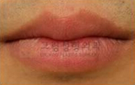 韩国格林整形收缩嘴唇前后对比照片