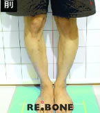 韩国利本韩-o型腿矫正对比日记