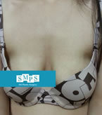 SMPS整形外科-胸部下垂矫正对比日记