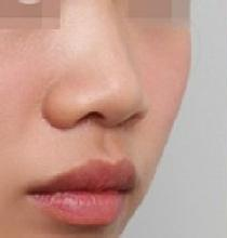假体隆鼻手术案例对比图