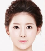 韩国KIWI整形外科-眼睛+鼻子+脂肪填充综合整形对比日记