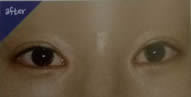 韩国TL整形医院-双眼皮部分切开法