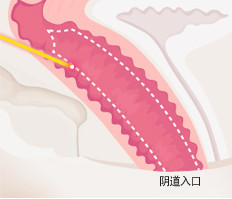 韩国如妍妇科医院-阴道整形对比图