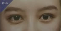 韩国TL整形医院-双眼皮埋线法对比图