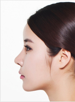 韩国A特医院隆鼻手术对比图