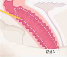 韩国如妍妇科医院-阴道整形对比图