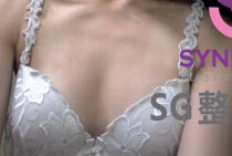 韩国SG整形外科-SG隆胸对比日记