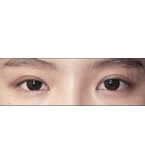 韩国清潭优整形-双眼皮+开眼角手术对比日记